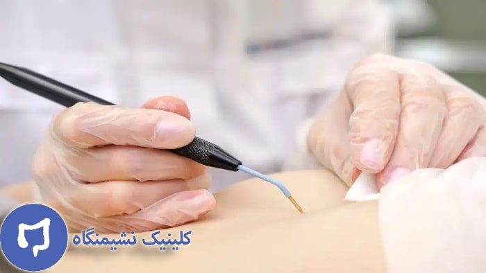 عکس درمان زگیل تناسلی در مردان و زنان