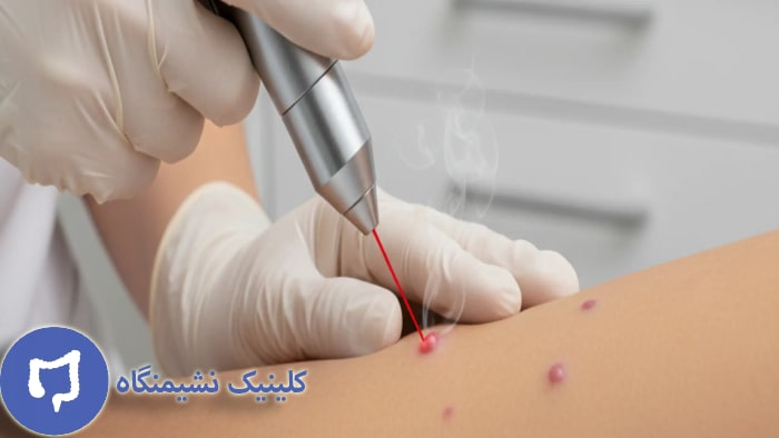 عکس درمان قطعی زگیل تناسلی