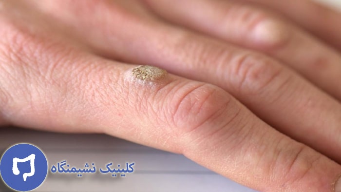 عکس از زگیل انگشت دست