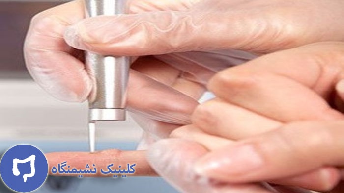 عکس درمان زگیل دست با لیزر