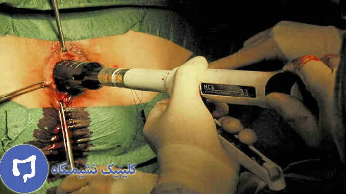عکس درمان بواسیر