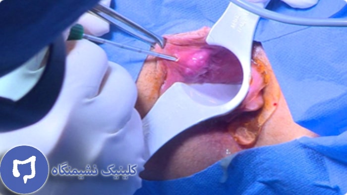 عکس درمان بواسیر با لیزر