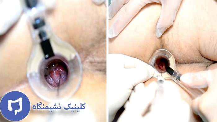 عکس عمل بواسیر با لیزر