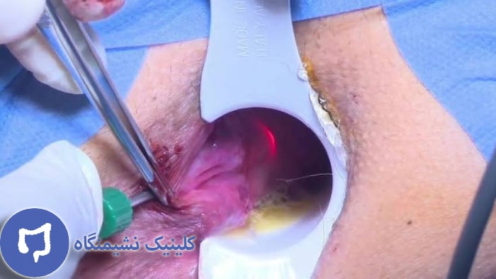عکس درمان هموروئید