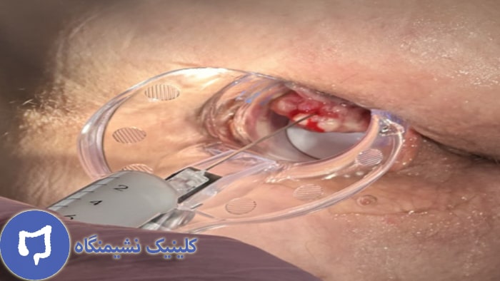 عکس هموروئید