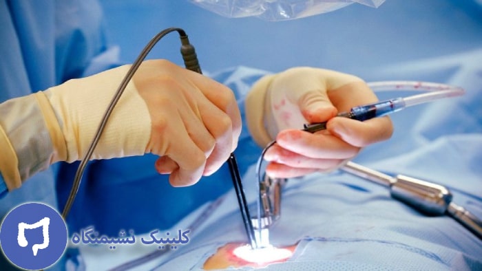 عکس مقایسه هزینه لیزر بواسیر و عمل جراحی