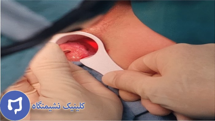 عکس جراحی بواسیر با لیزر