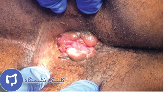 عکس بواسیر خونی