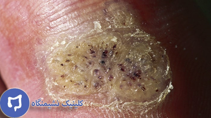 عکس زگیل تناسلی و درمان آن در خانه