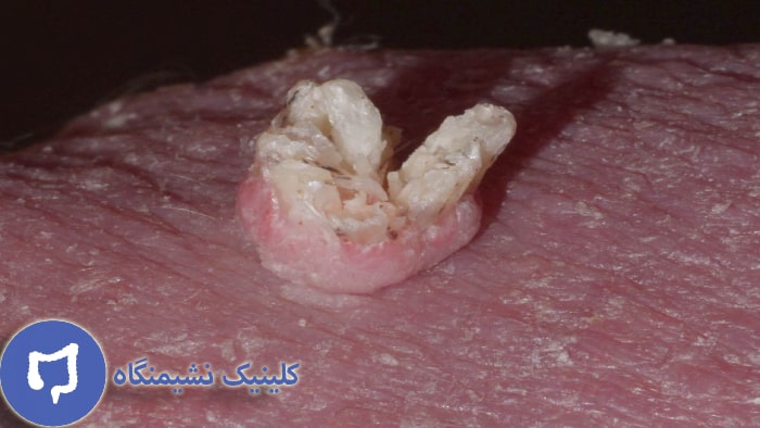 عکس تشخیص زگیل تناسلی با سرکه