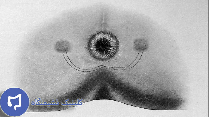 عکس فیستول نعل اسبی