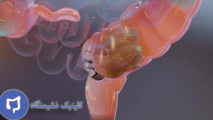 عکس عوارض یبوست