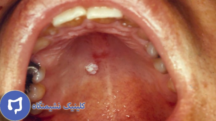 عکس اچ پی وی در دهان