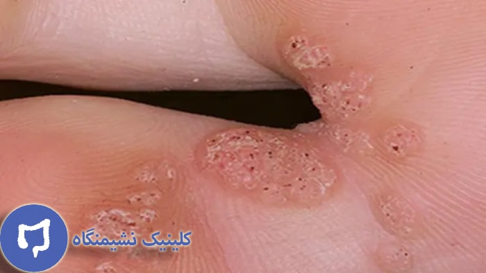 عکس hpv در پا