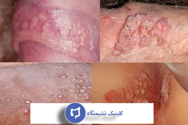 عکس علائم hpv