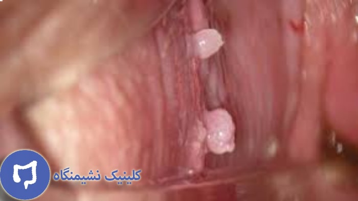 عکس زگیل تناسلی داخل واژن