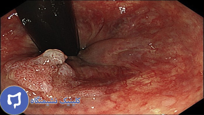 عکس زگیل داخل مقعد