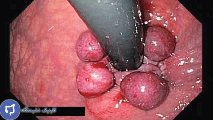 عکس بواسیر دکمه ای