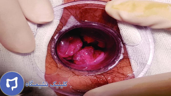 عکس درمان بواسیر داخلی