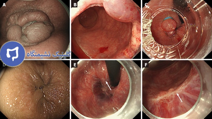عکس هموروئید داخلی
