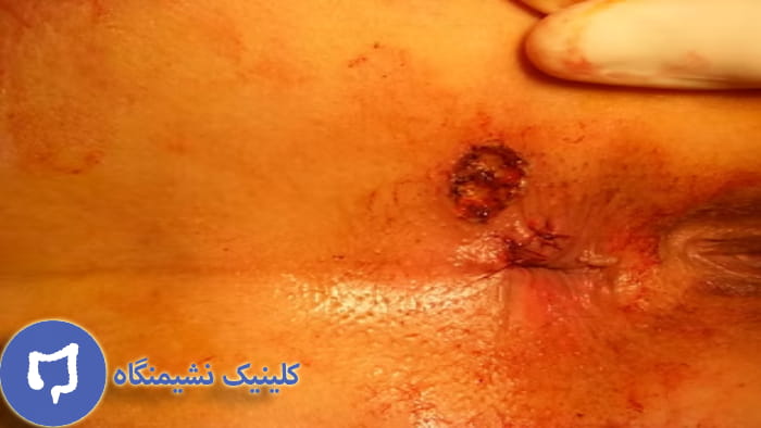 عکس فیستول بین اسفنکتری