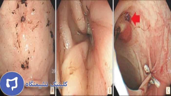 عکس فیستول روده