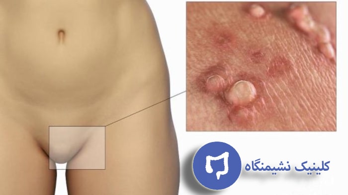 عکس انواع زگیل تناسلی در زنان