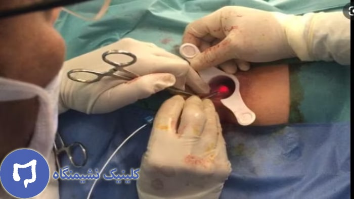 عکس درمان شقاق با لیزر