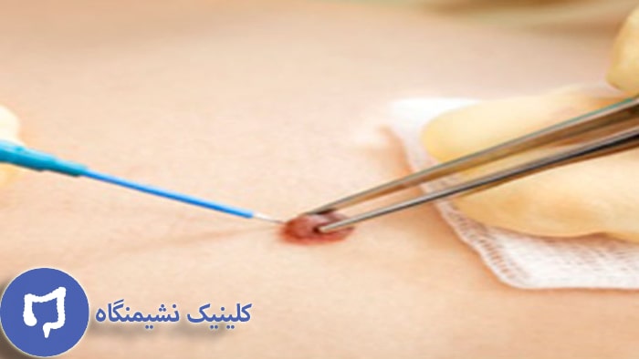 عکس درمان زگیل تناسلی در مردان