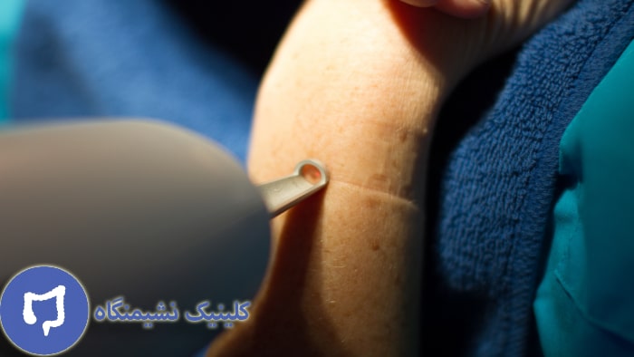 عکس درمان زگیل تناسلی در مردان