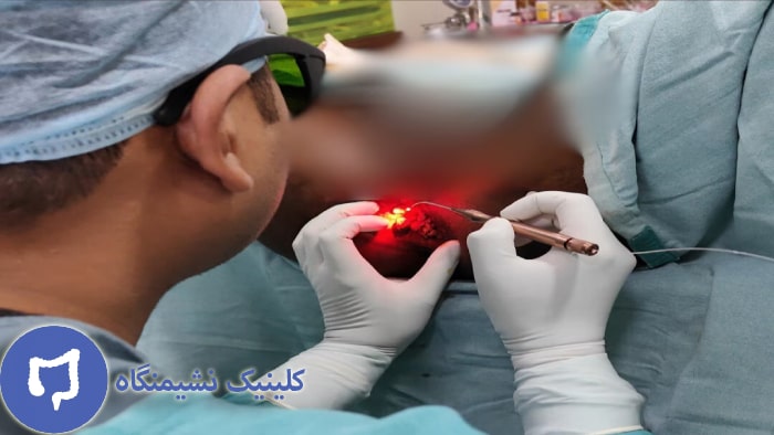 عکس لیزر شقاق