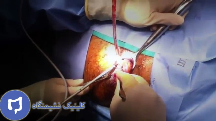 عکس جراحی لیزر بواسیر