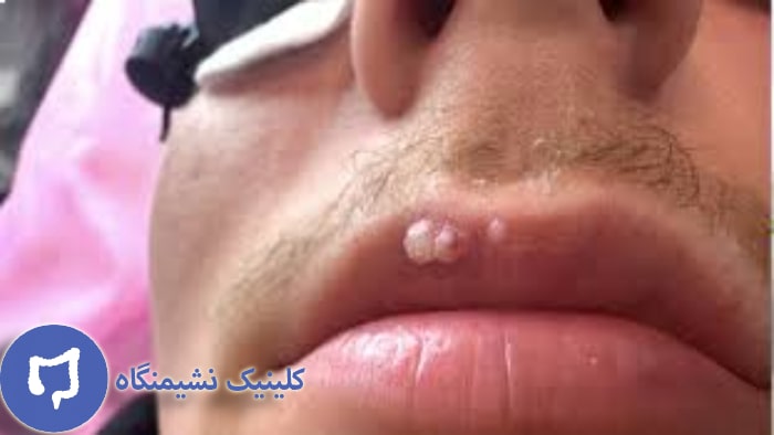 عکس زگیل لب