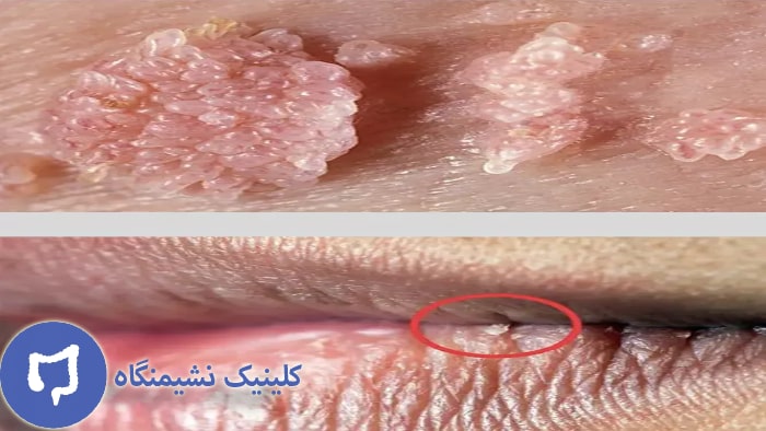 عکس زگیل صورت در ناحیه لب