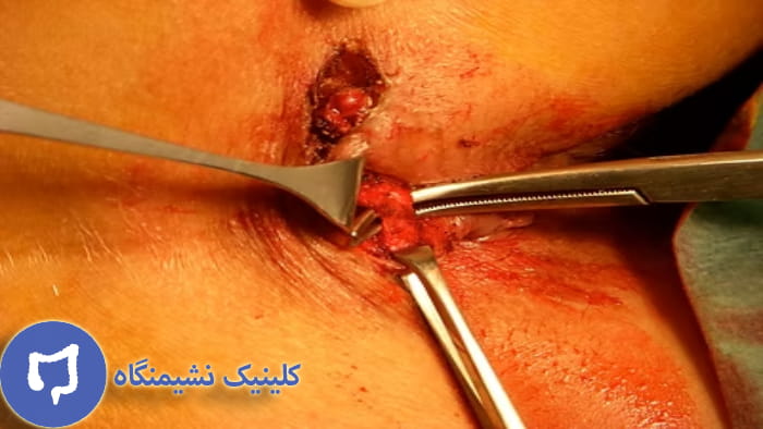 عکس علت تشکیل فیستول مقعدی پیچیده