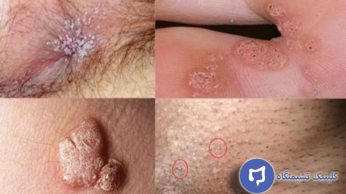 عکس بهترین دارو برای از بین بردن زگیل تناسلی