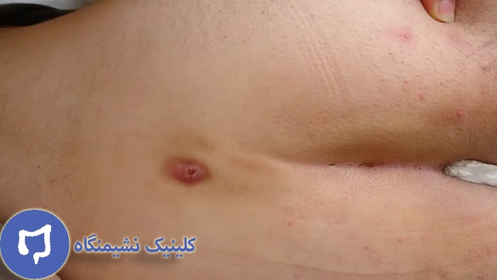 عکس درمان کیست مویی با دارو