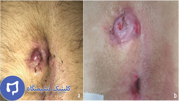 عکس درمان دارویی کیست مویی