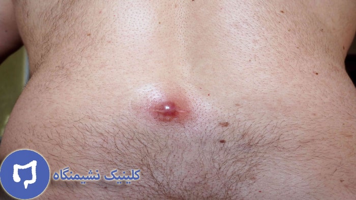 عکس درمان دارویی کیست مویی