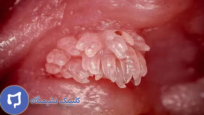 عکس اچ پی وی در دهان