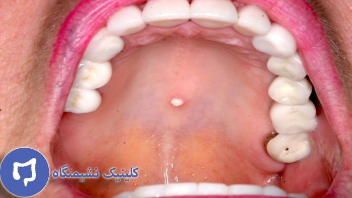 عکس زگیل دهانی خفیف