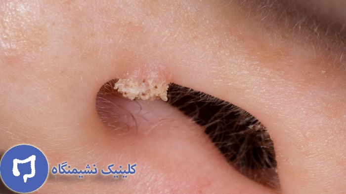 عکس زگیل صورت در بینی