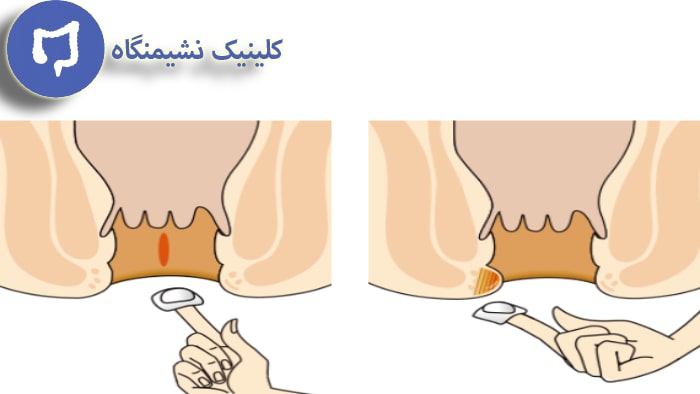 عکس نحوه استفاده پماد بعد از عمل فیستول