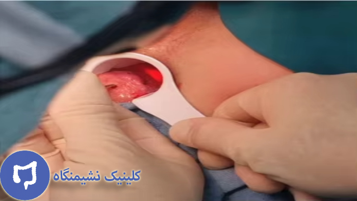 عکس لیزر شقاق