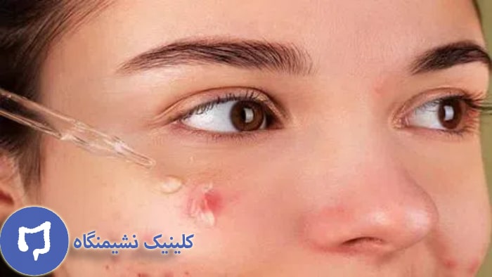 عکس پماد برای زگیل صورت