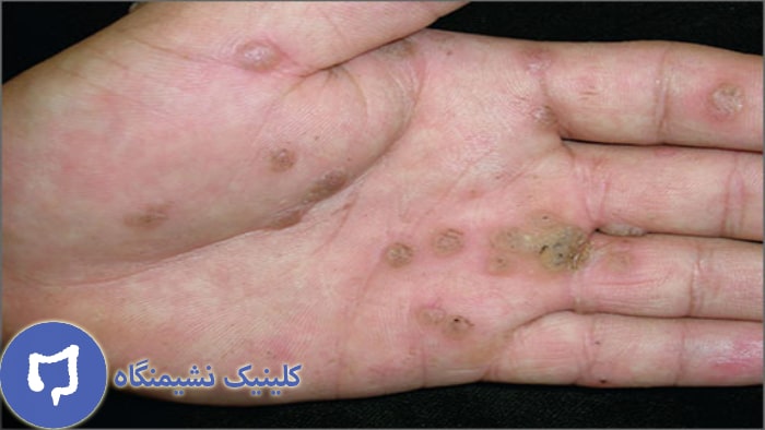 عکس زگیل دست