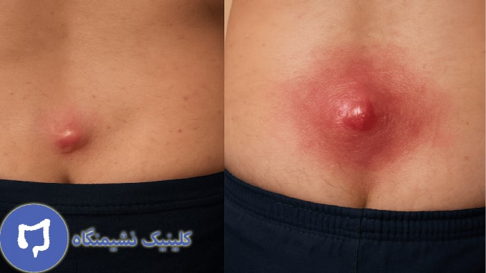 کیست مویی چیست با عکس