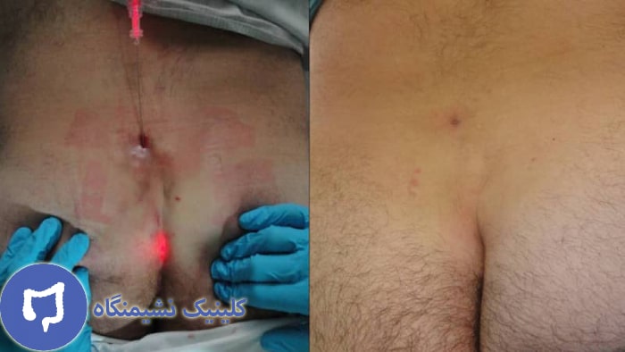 عکس درمان کیست مویی با لیزر در مقایسه با روش خانگی