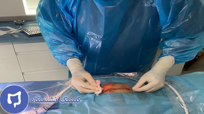 عکس عمل لیزر کیست مویی