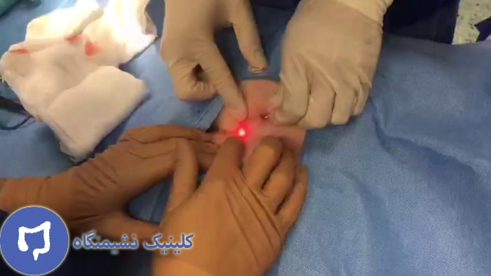 عکس درمان کیست مویی با لیزر